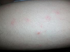 皮炎湿疹的症状有哪些？
