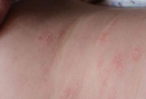 皮肤癣的症状仅仅是瘙痒吗？