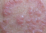 皮肤癣给患者造成的影响有哪些?