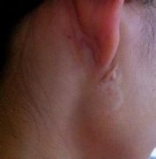 打耳洞留下了疤痕该怎么办呢?
