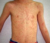 湿疹是如何引起的?