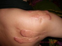 什么原因造成疤痕增生？