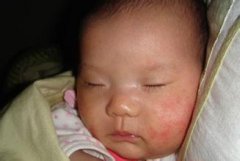 婴儿湿疹该如何预防？