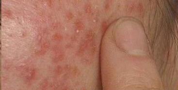 脂溢性皮炎的病因都有哪些？