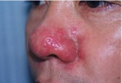 酒糟鼻早期的症状有哪些呢？