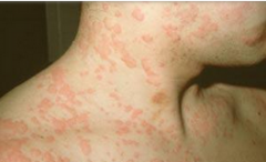 为什么会患上荨麻疹？
