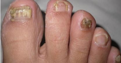 灰指甲的传染源有哪些？