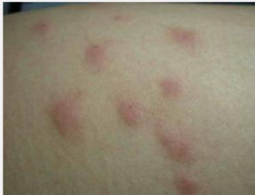 过度的劳累也会导致荨麻疹吗